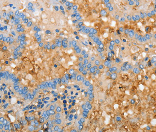 Immunohistochemistry of paraffin-embedded Human thyroid cancer using APOH Polyclonal Antibody at dilution of 1:30