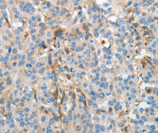 Immunohistochemistry of paraffin-embedded Human esophagus cancer using APOH Polyclonal Antibody at dilution of 1:30