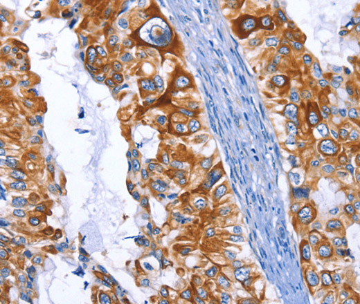 Immunohistochemistry of paraffin-embedded Human cervical cancer tissue using ARRB1 Polyclonal Antibody at dilution 1:50