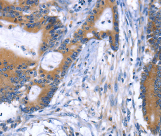 Immunohistochemistry of paraffin-embedded Human colon cancer tissue using ARRB1 Polyclonal Antibody at dilution 1:50