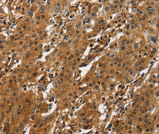 Immunohistochemistry of paraffin-embedded Human gasrtic cancer tissue using CREB2 Polyclonal Antibody at dilution 1:50