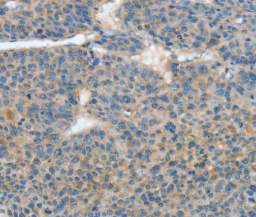 Immunohistochemistry of paraffin-embedded Human liver cancer tissue using ATP4B Polyclonal Antibody at dilution 1:40