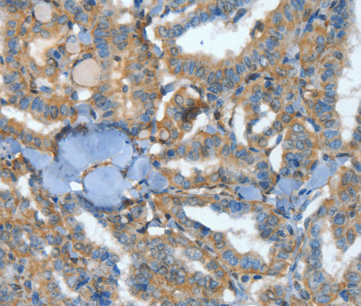 Immunohistochemistry of paraffin-embedded Human thyroid cancer tissue using ATP4B Polyclonal Antibody at dilution 1:40