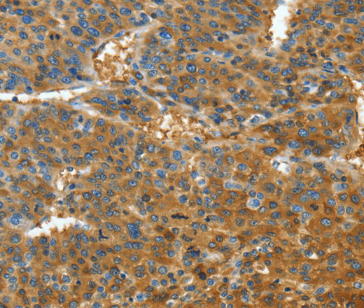 Immunohistochemistry of paraffin-embedded Human liver cancer tissue using TNFSF13B Polyclonal Antibody at dilution 1:30