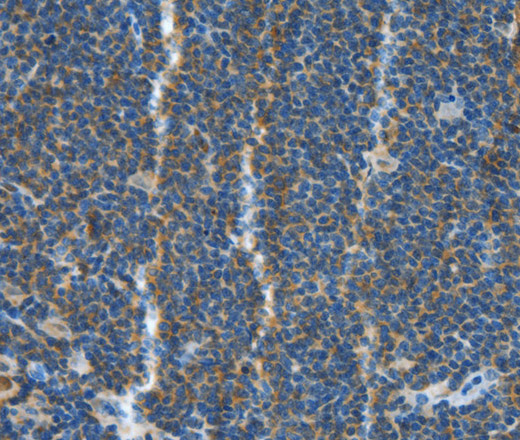 Immunohistochemistry of paraffin-embedded Human lymphoma tissue using TNFSF13B Polyclonal Antibody at dilution 1:30