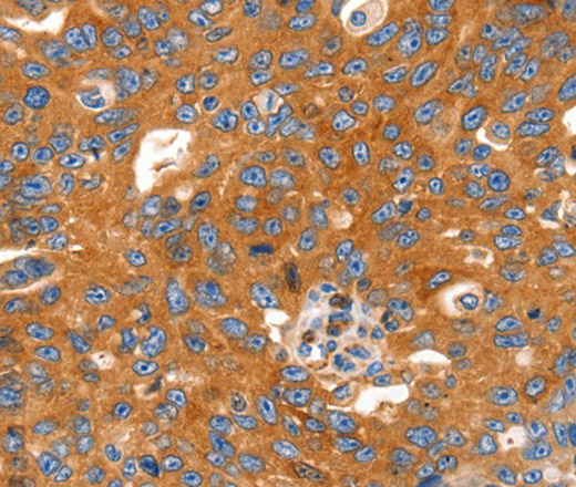 Immunohistochemistry of paraffin-embedded Human ovarian cancer using CAP2 Polyclonal Antibody at dilution of 1:60