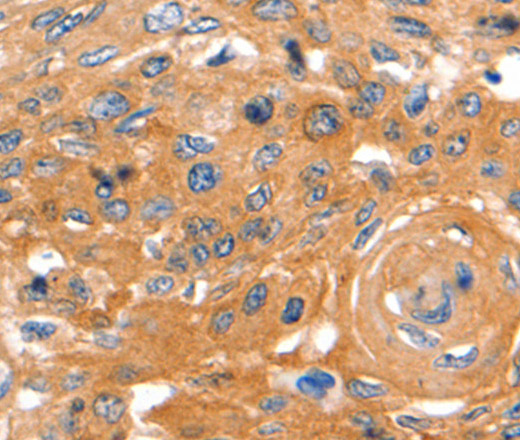 Immunohistochemistry of paraffin-embedded Human cervical cancer using CAP2 Polyclonal Antibody at dilution of 1:60