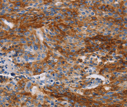 Immunohistochemistry of paraffin-embedded Human liver cancer tissue using CA9 Polyclonal Antibody at dilution 1:40