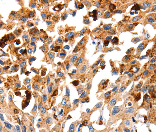 Immunohistochemistry of paraffin-embedded Human lung cancer tissue using Cathepsin B Polyclonal Antibody at dilution 1:35