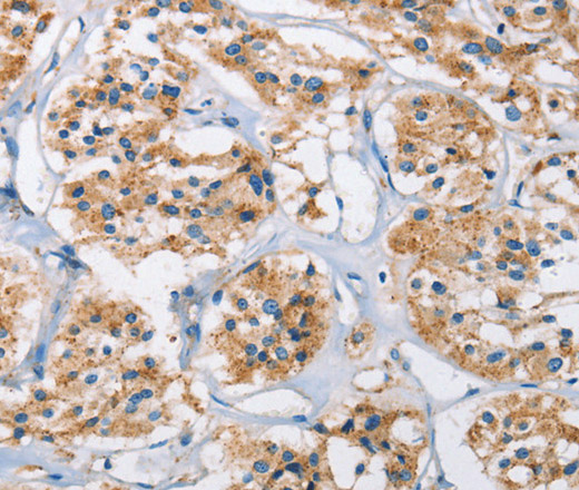 Immunohistochemistry of paraffin-embedded Human thyroid cancer using Cathepsin L Polyclonal Antibody at dilution of 1:40