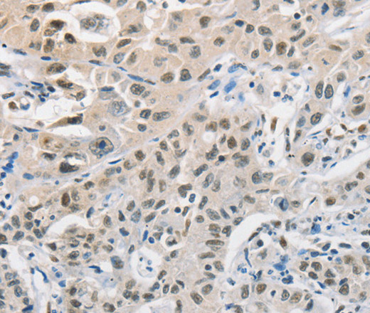 Immunohistochemistry of paraffin-embedded Human lung cancer tissue using CDC27 Polyclonal Antibody at dilution 1:50