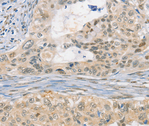 Immunohistochemistry of paraffin-embedded Human cervical cancer tissue using CDC27 Polyclonal Antibody at dilution 1:50