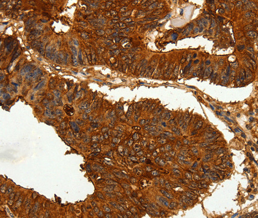 Immunohistochemistry of paraffin-embedded Human colon cancer tissue using CEACAM21 Polyclonal Antibody at dilution 1:60