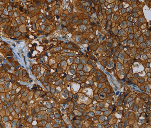 Immunohistochemistry of paraffin-embedded Human breast cancer tissue using ERBB4 Polyclonal Antibody at dilution 1:40