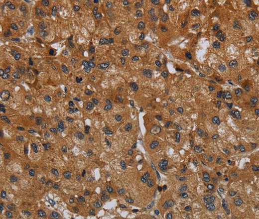 Immunohistochemistry of paraffin-embedded Human liver cancer tissue using ERBB4 Polyclonal Antibody at dilution 1:40