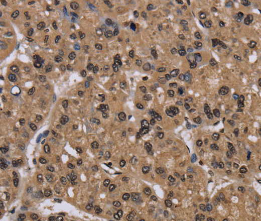 Immunohistochemistry of paraffin-embedded Human liver cancer using CSNK2A1 Polyclonal Antibody at dilution of 1:30