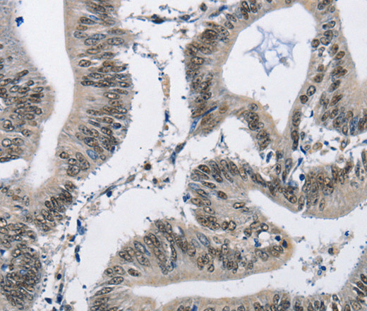 Immunohistochemistry of paraffin-embedded Human colon cancer tissue using CMTM2 Polyclonal Antibody at dilution 1:60