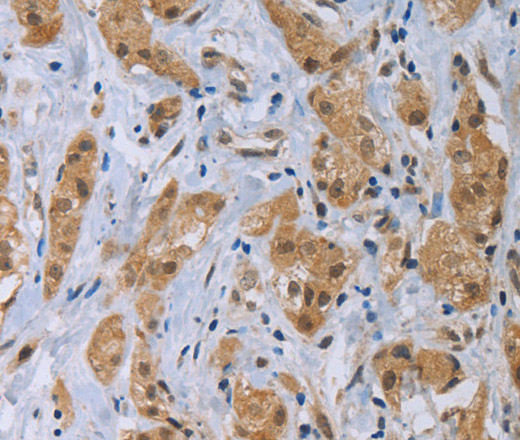 Immunohistochemistry of paraffin-embedded Human breast cancer tissue using CLEC1A Polyclonal Antibody at dilution 1:40