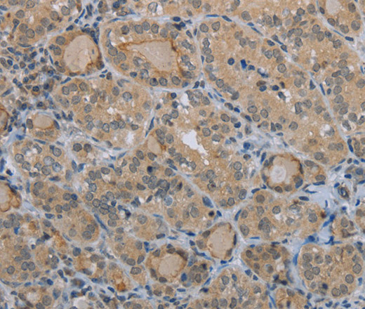 Immunohistochemistry of paraffin-embedded Human thyroid cancer tissue using CLEC1A Polyclonal Antibody at dilution 1:40