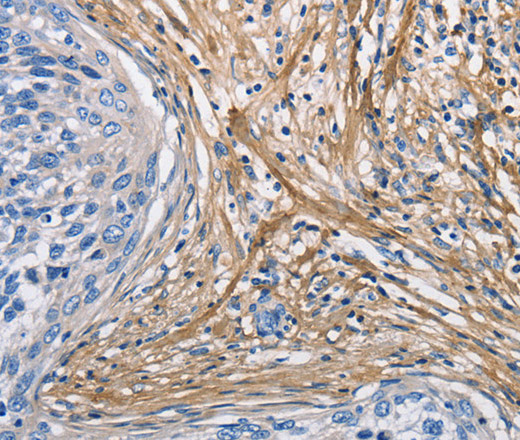 Immunohistochemistry of paraffin-embedded Human cervical cancer tissue using COL3A1 Polyclonal Antibody at dilution 1:60