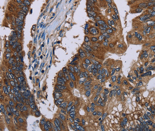 Immunohistochemistry of paraffin-embedded Human colon cancer tissue using CLDND1 Polyclonal Antibody at dilution 1:40
