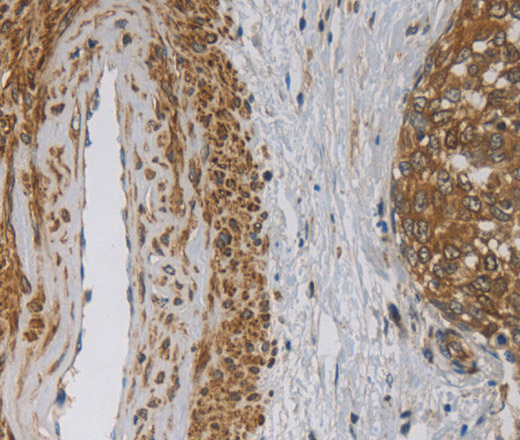 Immunohistochemistry of paraffin-embedded Human cervical cancer using EMC8 Polyclonal Antibody at dilution of 1:30