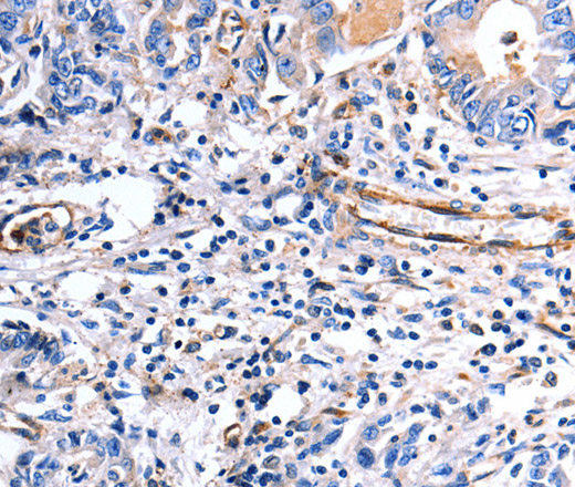 Immunohistochemistry of paraffin-embedded Human stomach cancer using COX11 Polyclonal Antibody at dilution of 1:30