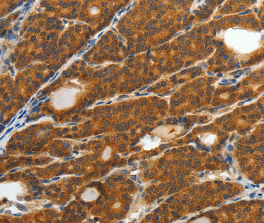 Immunohistochemistry of paraffin-embedded Human thyroid cancer using CRP Polyclonal Antibody at dilution of 1:40