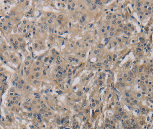 Immunohistochemistry of paraffin-embedded Human gastric cancer tissue using DCN Polyclonal Antibody at dilution 1:30