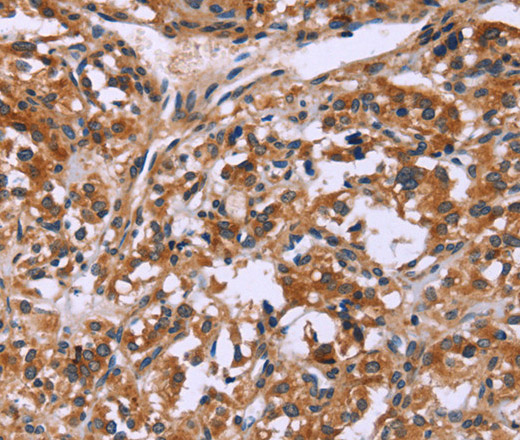 Immunohistochemistry of paraffin-embedded Human thyroid cancer tissue using CD107b Polyclonal Antibody at dilution 1:30