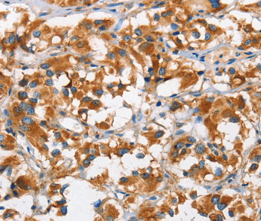 Immunohistochemistry of paraffin-embedded Human thyroid cancer using DKK3 Polyclonal Antibody at dilution of 1:50