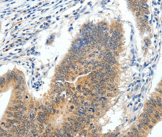 Immunohistochemistry of paraffin-embedded Human colon cancer tissue using ECE2 Polyclonal Antibody at dilution 1:40