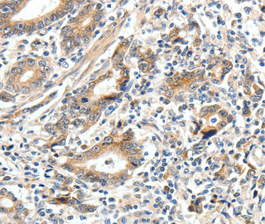 Immunohistochemistry of paraffin-embedded Human gastric cancer tissue using ECE2 Polyclonal Antibody at dilution 1:40