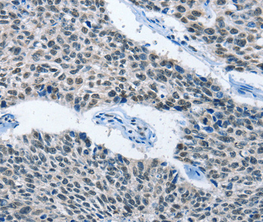 Immunohistochemistry of paraffin-embedded Human lung cancer using ELAVL1 Polyclonal Antibody at dilution of 1:50