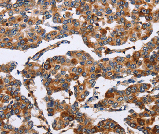 Immunohistochemistry of paraffin-embedded Human breast cancer tissue using ENPP5 Polyclonal Antibody at dilution 1:60