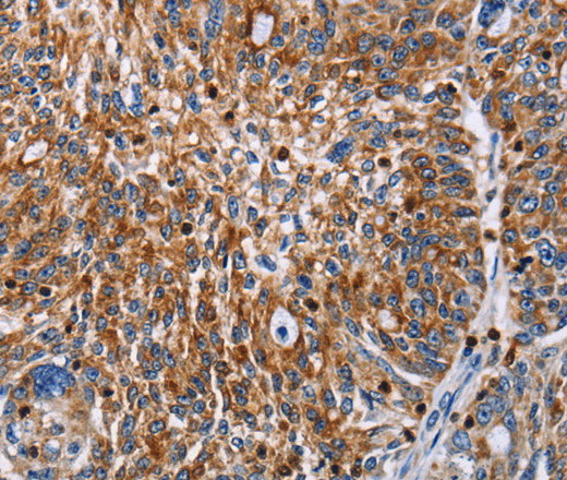 Immunohistochemistry of paraffin-embedded Human ovarian cancer tissue using ENPP5 Polyclonal Antibody at dilution 1:60