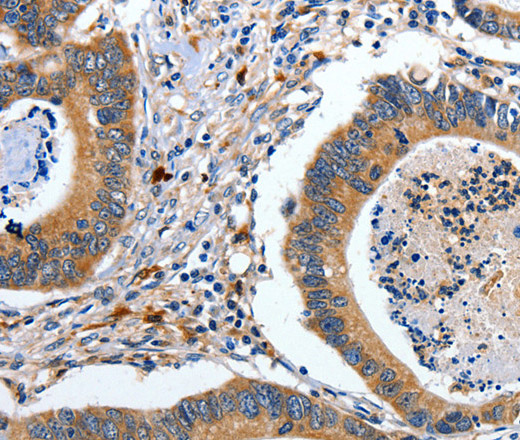 Immunohistochemistry of paraffin-embedded Human colon cancer tissue using EFNB2 Polyclonal Antibody at dilution 1:80