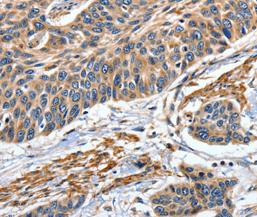 Immunohistochemistry of paraffin-embedded Human esophagus cancer tissue using EFNB2 Polyclonal Antibody at dilution 1:80