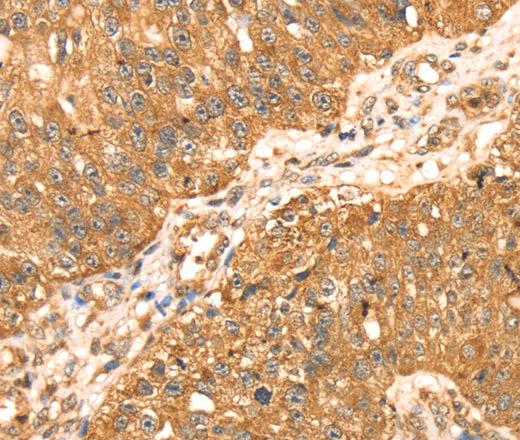 Immunohistochemistry of paraffin-embedded Human breast cancer using ERK 5 Polyclonal Antibody at dilution of 1:35