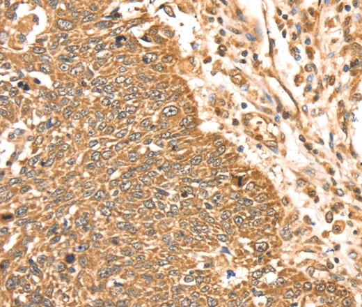 Immunohistochemistry of paraffin-embedded Human lung cancer using ERK 5 Polyclonal Antibody at dilution of 1:35