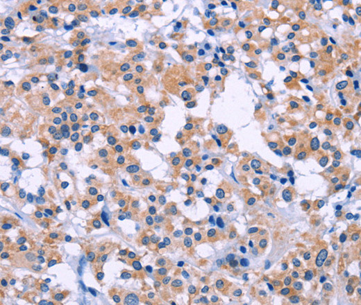 Immunohistochemistry of paraffin-embedded Human thyroid cancer tissue using DUSP22 Polyclonal Antibody at dilution 1:60