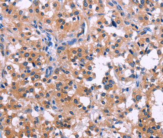 Immunohistochemistry of paraffin-embedded Human thyroid cancer tissue using DUSP13 Polyclonal Antibody at dilution 1:50