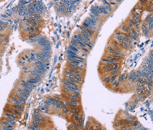 Immunohistochemistry of paraffin-embedded Human colon cancer tissue using DUSP13 Polyclonal Antibody at dilution 1:50