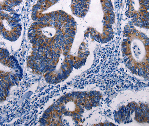 Immunohistochemistry of paraffin-embedded Human colon cancer tissue using MKP-3 Polyclonal Antibody at dilution 1:50