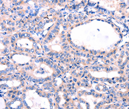 Immunohistochemistry of paraffin-embedded Human thyroid cancer tissue using DUSP12 Polyclonal Antibody at dilution 1:77