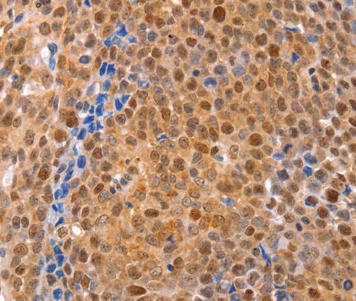 Immunohistochemistry of paraffin-embedded Human ovarian cancer using MKP-2 Polyclonal Antibody at dilution of 1:30