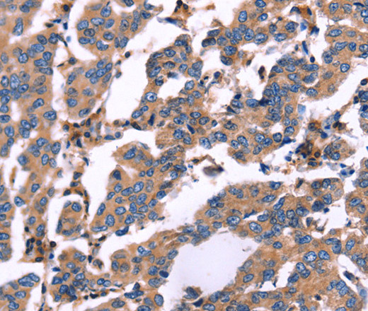 Immunohistochemistry of paraffin-embedded Human breast cancer using RDX Polyclonal Antibody at dilution of 1:60