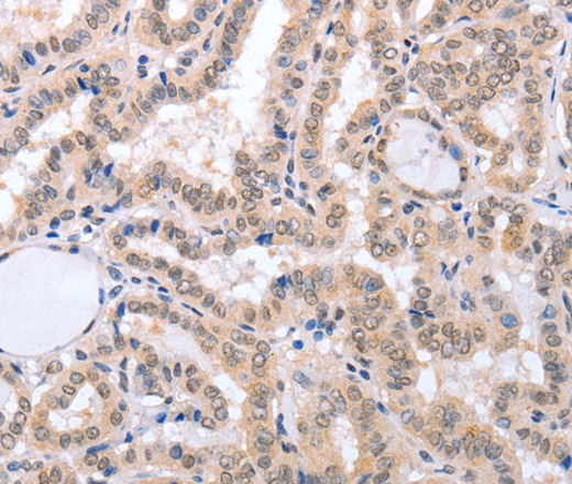 Immunohistochemistry of paraffin-embedded Human thyroid cancer tissue using FADD Polyclonal Antibody at dilution 1:50