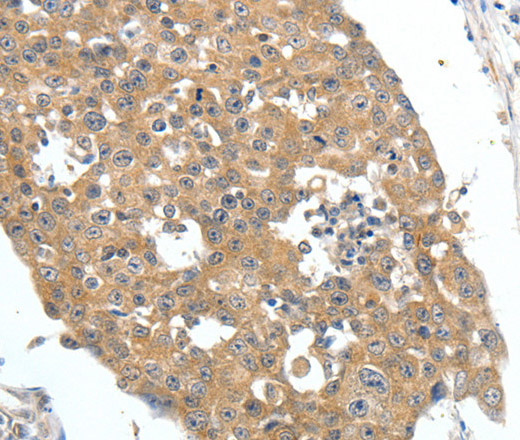 Immunohistochemistry of paraffin-embedded Human breast cancer tissue using FSHR Polyclonal Antibody at dilution 1:70