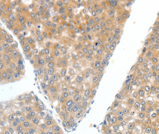 Immunohistochemistry of paraffin-embedded Human liver cancer tissue using FSHR Polyclonal Antibody at dilution 1:70